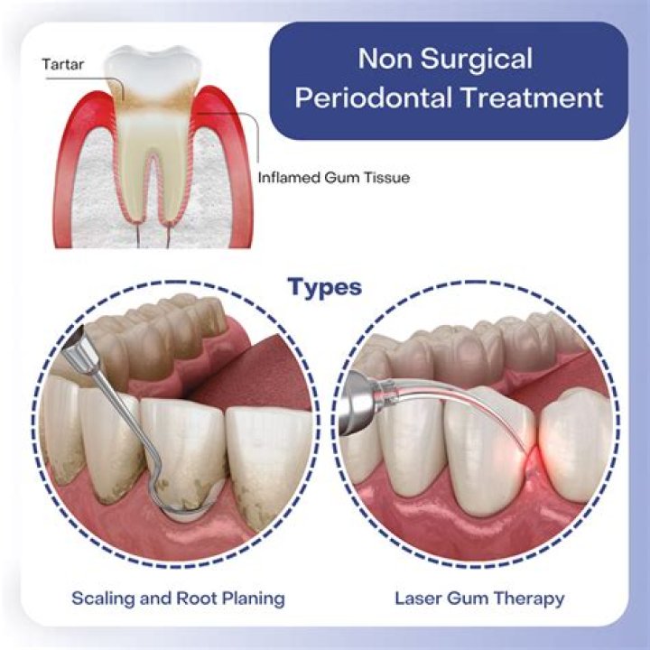 What instruments are used for periodontal treatment?